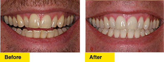 Before/After Inman Aligner