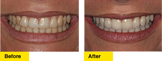 Before/After Upper Teeth Crowding