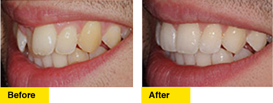 Before/After Crowding Lower Teeth