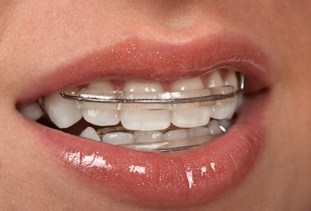 Clear Braces Fast Orthodontic Treatment