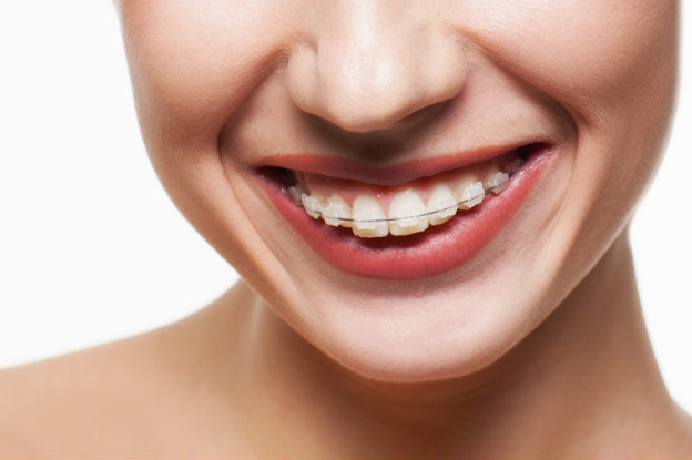 clear-braces-manchester-clear-braces-or-metal-braces
