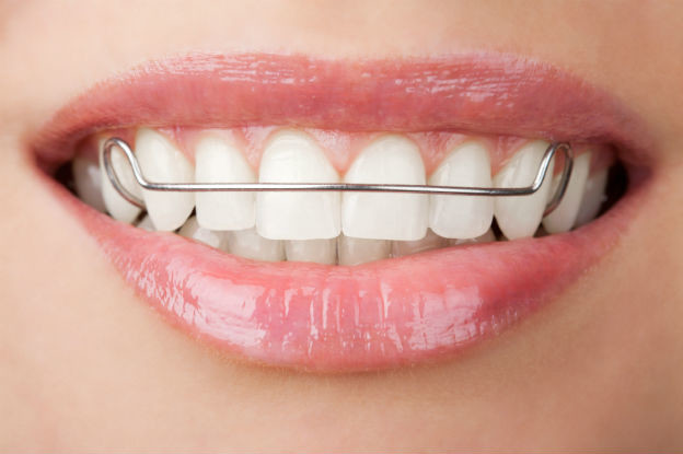 Clear Braces Manchester Inman Aligner Manchester Discussing The Pros and Cons