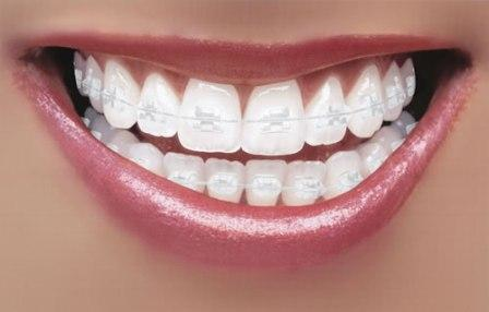 Clear Fixed Braces Manchester – How Do They Work?