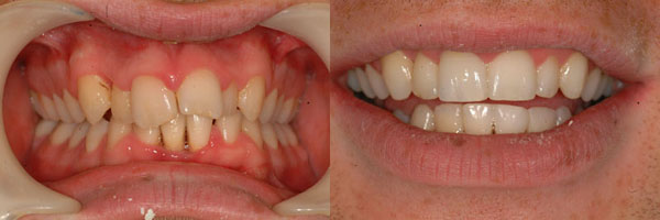 Inman Aligner Before and After – What A Difference 12 weeks Makes