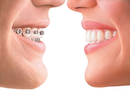 Orthodontist Manchester – Invisalign vs Lingual Braces