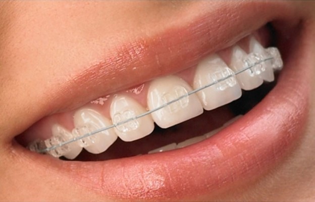 Clear Fixed Braces Manchester