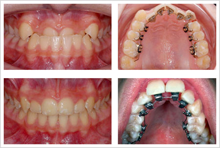 Lingual Hidden Braces in London  Behind the Teeth Braces : ODL