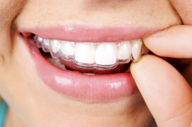 Fast Orthodontic Treatment – How It Differs From Standard Braces
