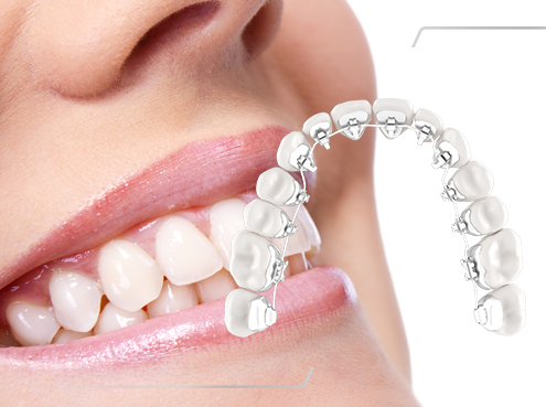 Lingual Braces Manchester -What Are They And How Do They Work