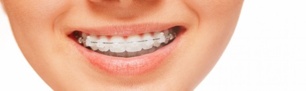 Fast Orthodontic Treatment – Does It Really Work
