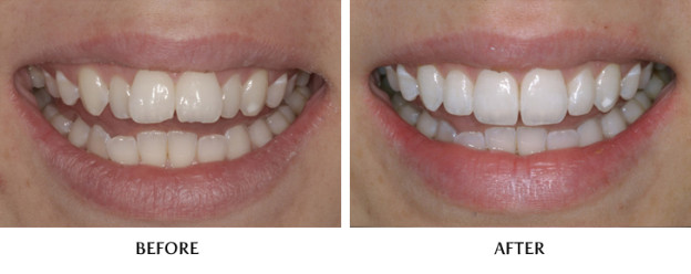 Inman Aligner Before And After - Fast Orthodontics At Their Best
