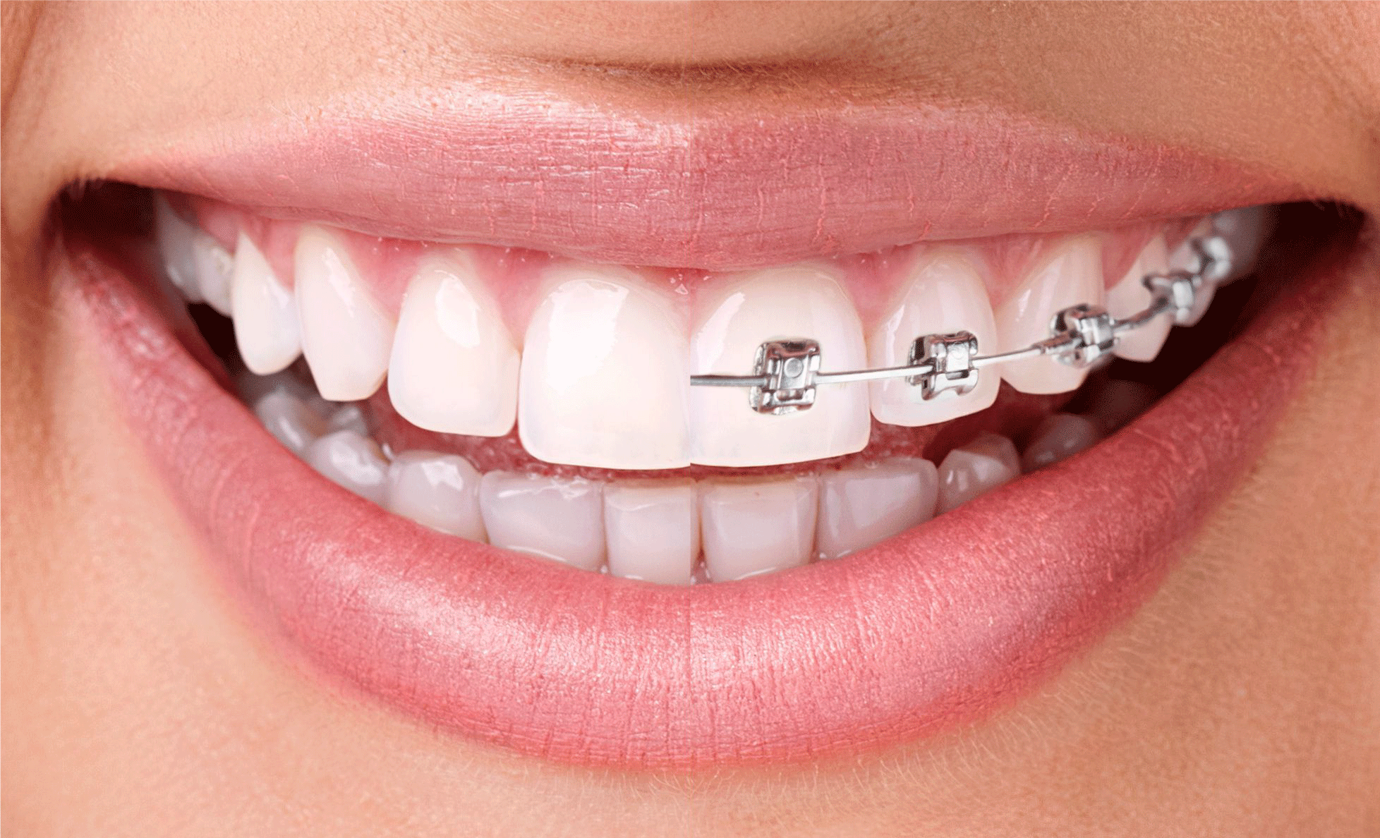 Invisalign Offers Manchester - An Alternative To Metal Braces