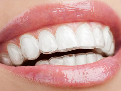 Invisalign Braces Manchester – Looking At The Pros And Cons