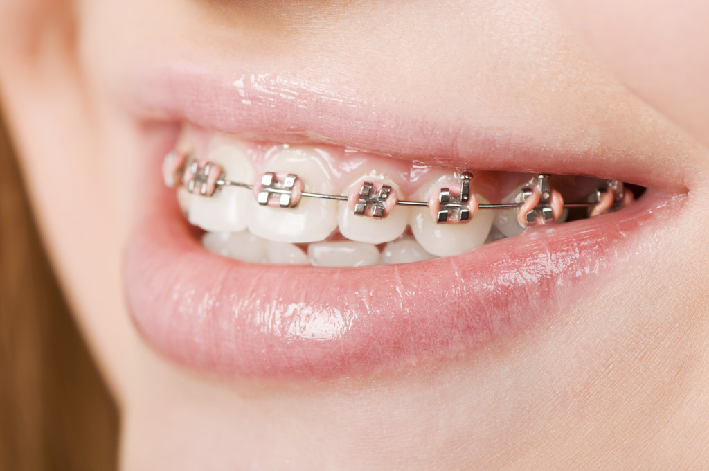 Orthodontic Braces In Manchester What Are The Various Types Blog
