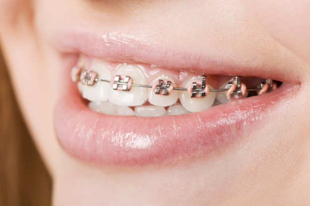 Orthodontics Manchester – How Do Braces Straighten Teeth?