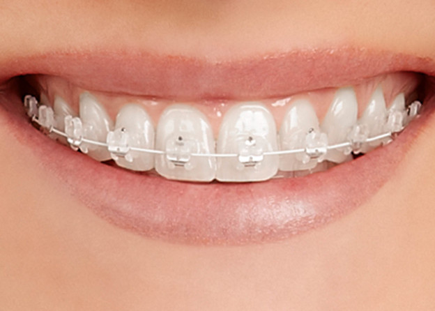 Restoring Your Smile With Clear Fixed Braces