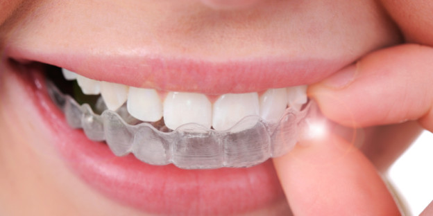 Clear View Braces - Why Are They So Popular