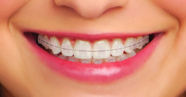 Fast Orthodontic Treatment – How It Differs From Standard Braces