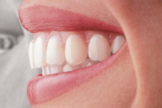 Lingual Braces Manchester – How They Differ From Other Systems