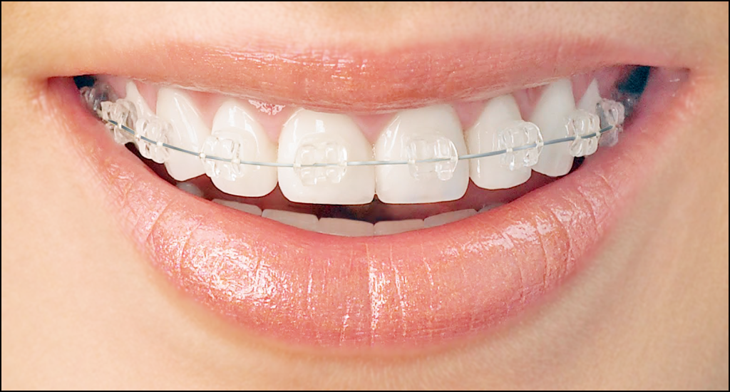 Clear View Braces Are They Better Than Invisalign? Blog