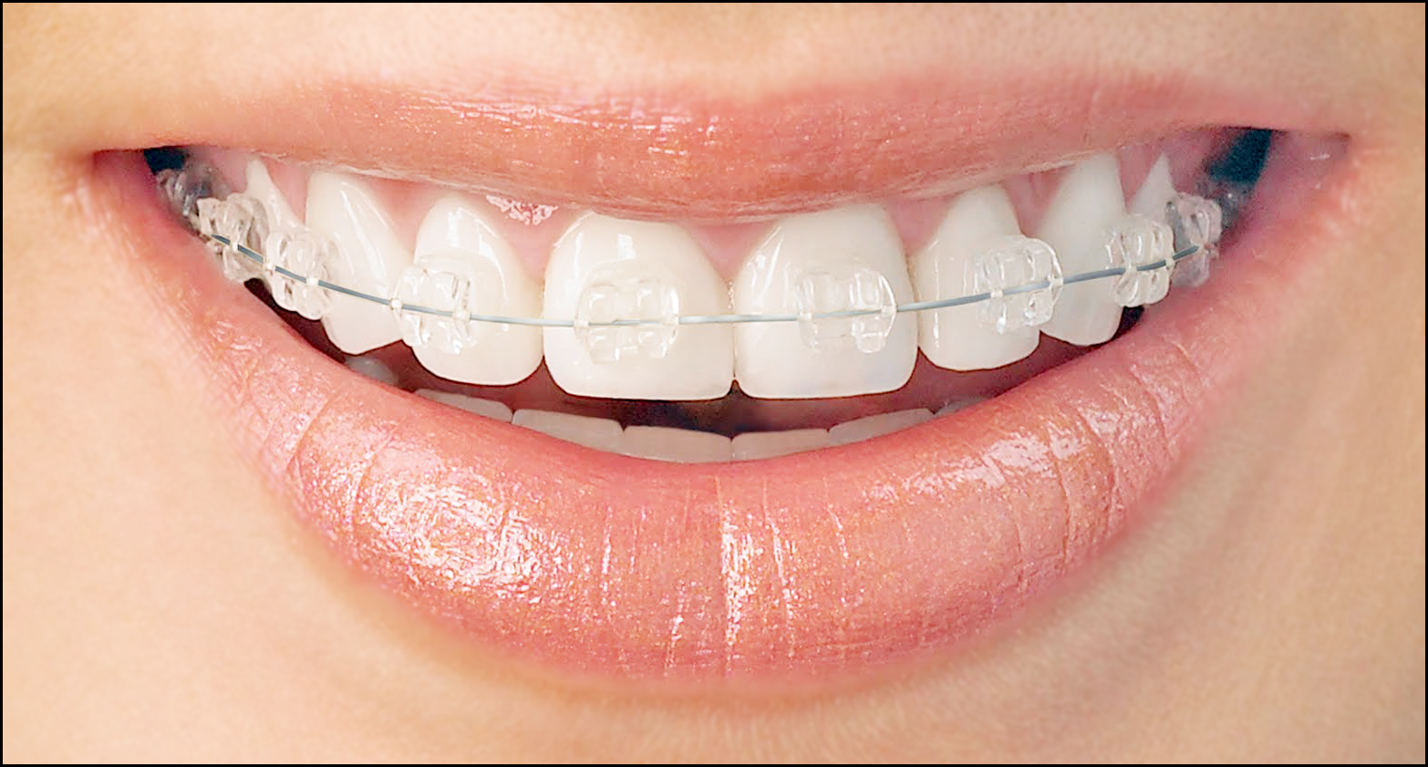 Fast Orthodontic Treatment How It Differs From Standard Braces Blog 