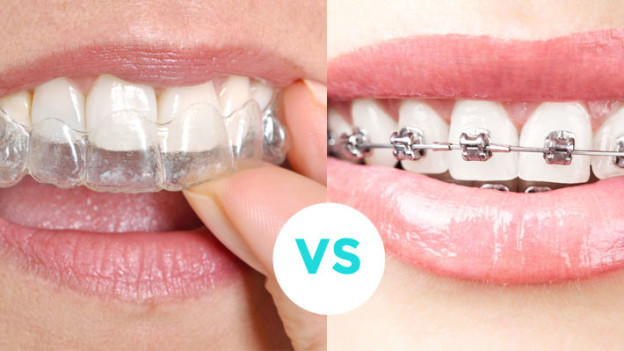 Lingual braces Manchester Or Invisalign – A New Breed Of Braces