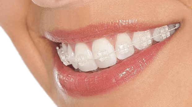 Invisible Braces – What Are They And How They Can Help