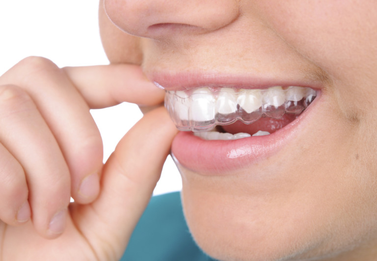 Invisible Braces Manchester The Various Types Explained Blog