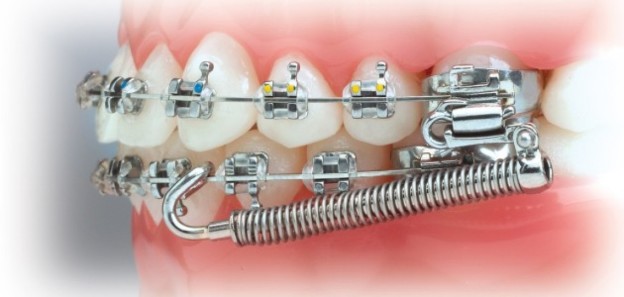 Orthodontics Manchester – The 4 Different Types Explained