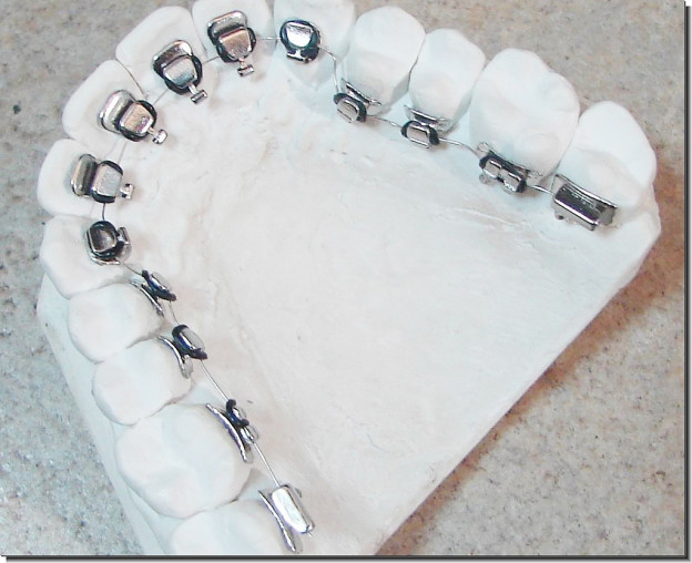 Lingual Braces Before And After – How They Straighten Teeth